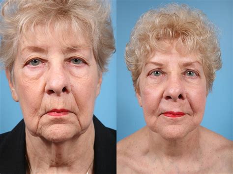 Neck Lift Before And After Photos Patient 67 Chicago Il Tlkm Plastic Surgery