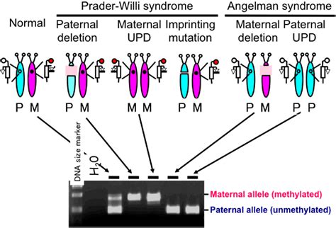 Chromosome 15 Deletion Angelman Syndrome And Praderwilli Syndrome