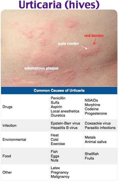 Urticaria Urticariawhealshives Ige Mediated Reaction To Allergen