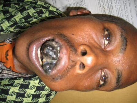 A dog with cancer will display a few symptoms such as lethargy, lack of appetite, swellings, slow healing of wounds or lumps on the surface of the skin. Cancer, malignant melanoma. Causes, symptoms, treatment ...