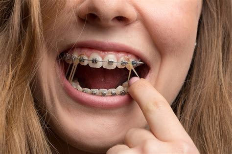 What Are Elastics And What Do They Do Rick Herrmann Orthodontics