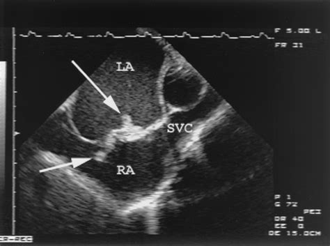Patent Foramen Ovale A Review Of Associated Conditions And The Impact