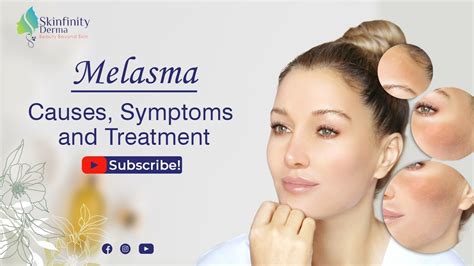 Melasma Causes Signs Symptoms And Treatment Part 1 Youtube