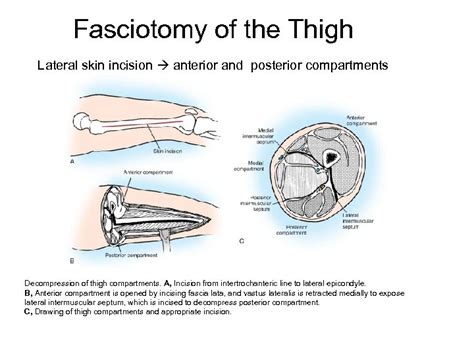 Compartment Syndrome And Fasciotomy Supparerk Prichayudh M D