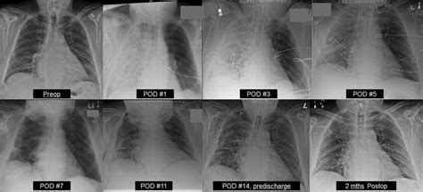 Serial Chest Radiographs Of A 67 Year Old Patient With Moderate Chronic