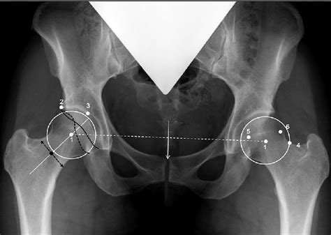 Anteroposterior Pelvic Radiograph And The Points And Lines Of Reference