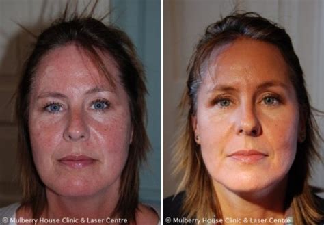 My treating therapist has recommended 2 weeks before and after each ipl session, but this seems overly conservative. Before and After Photos - Rosacea| Mulberry House Clinic