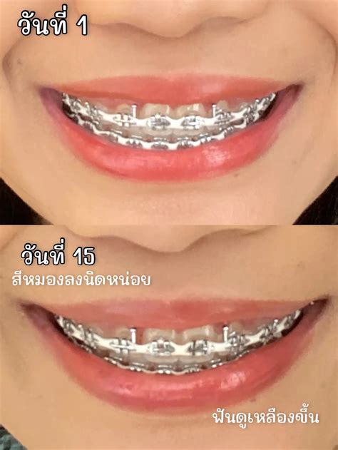 รีวิวยางจัดฟันสีขาว🦷 ใส่แล้วรอดมั๊ย ดูแลยังไงให้สีไม่หมอง แกลเลอรี