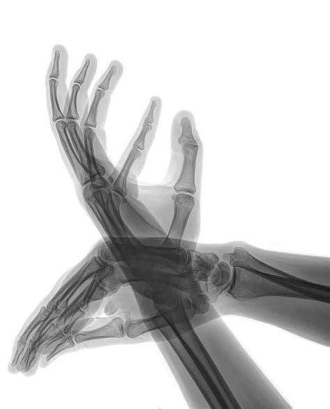 X Ray Of Hands Photograph By Photostock Israelscience Photo Library