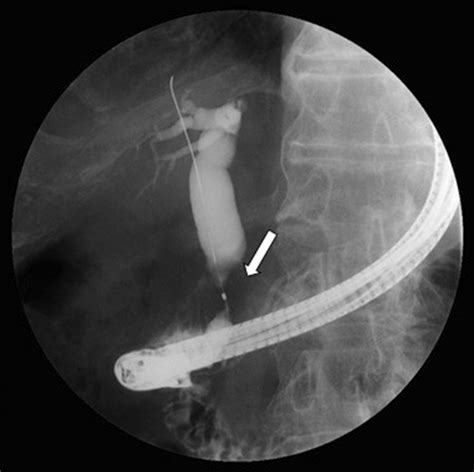 Endoscopic Retrograde Cholangiopancreatography Ercp Showing A Distal