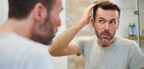 5 Early Signs Of Balding And What To Do Next Innovations Medical