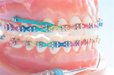 Orthodontic Mini Screw Dentram Dental Clinics