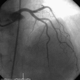 Cardiac CT-Scan showed a complete stent fracture and ...