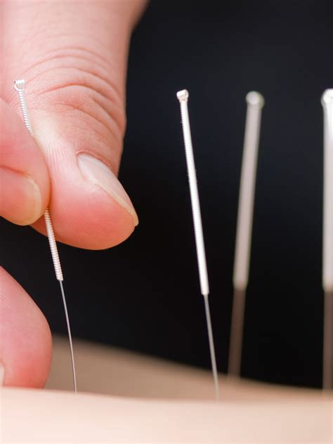 acupuncture and dry needling spphysiotherapy