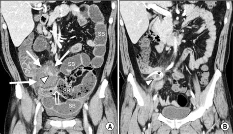 A 46 Year Old Man Who Had A Perforated Appendicitis With An Appendiceal