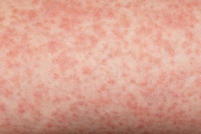 Scarlet Fever Stock Image C023 4294 Science Photo Library
