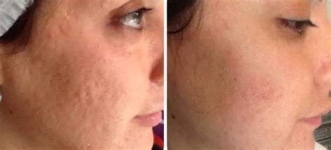 Scheitel Auswandern verkürzen tratament cu laser pentru semne acnee