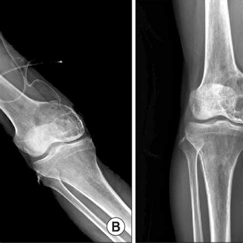 Aneurysmal Bone Cyst Of Distal Femur In A 51 Year Old Patient A