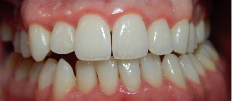 Take Immediate Action To Fight Against Advanced Form Of Gingivitis