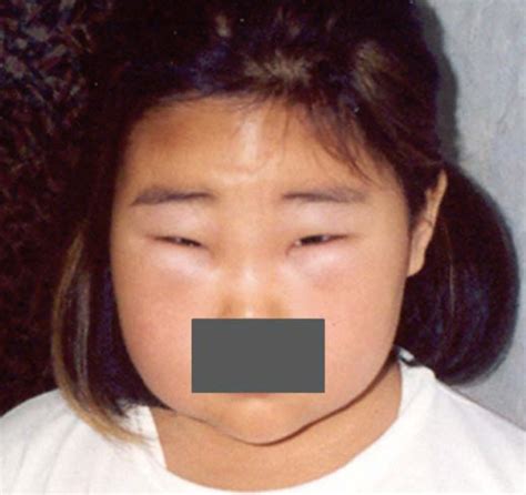 The Swollen Face Of The Patient During An Attack Of Angioedema
