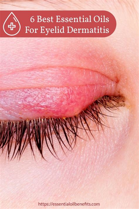 How To Treat Eyelid Dermatitis At Home Treat Mania