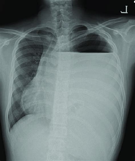 Initial Chest X Ray Shows An Opacified Hemithorax With Contralateral