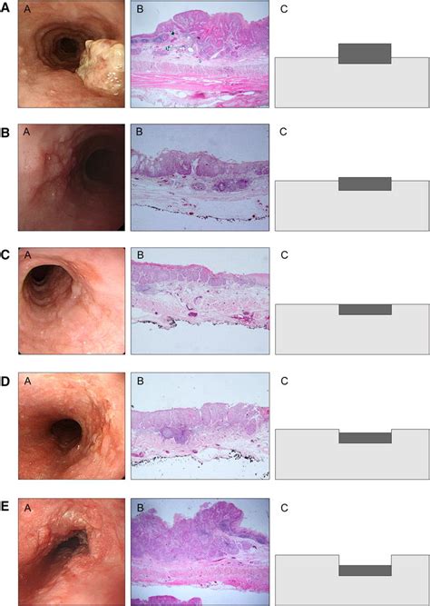 Clinical Implication Of Endoscopic Gross Appearance In Superficial