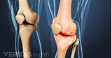 Alternative Treatments For Arthritis Knee Pain Images