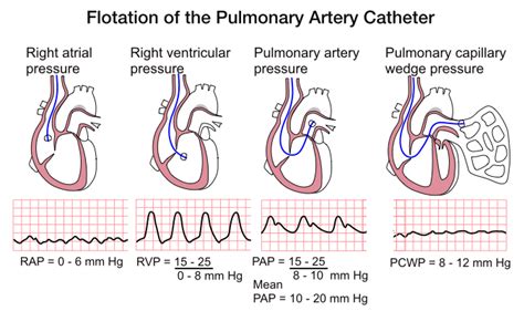 Pa Catheter Pressures Cath Lab Nursing Nursing Tips Nursing Study