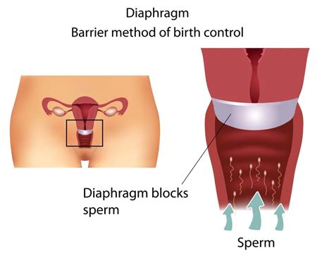 Birth Control How To Use Your Diaphragm