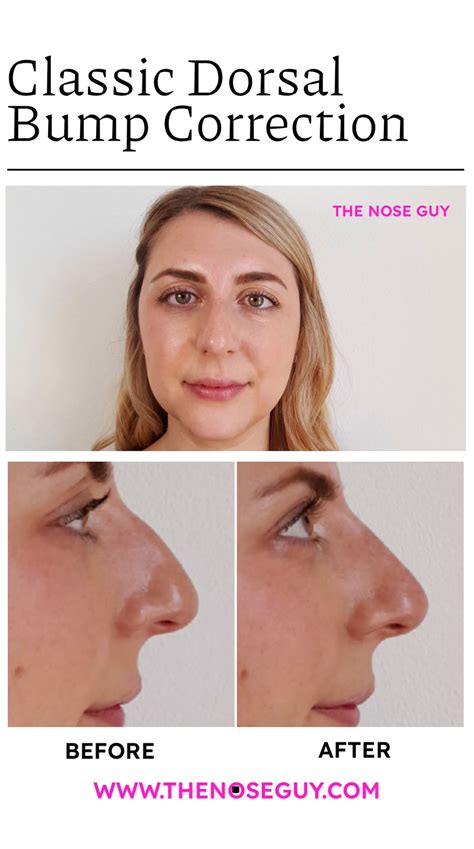 The Classic Dorsal Bump Nose Job