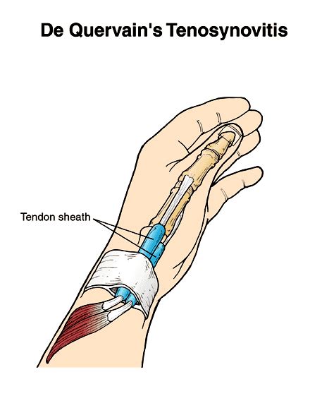 This results in pain at the outside of the wrist. DeQuervain's Tenosynovitis Missouri | Pain Prevent