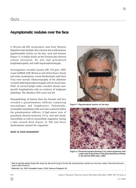 Pdf Quiz Asymptomatic Nodules Over The Face
