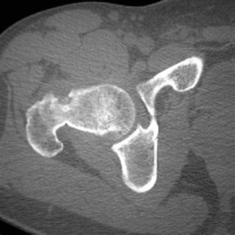 Mr Arthrogram Of The Right Hip Showing A Lesion Located At The Base Of