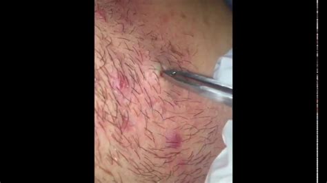 Gross And Graphic Huge Ingrown Hairs Inside Neck Youtube
