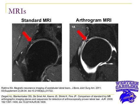 Right Hip Labral Tear In A 22 Year Old Collegiate Male