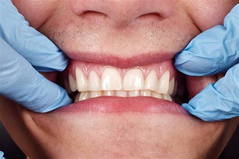 Receding Gums And 6 Other Signs Of Gum Disease Tompkins Dental