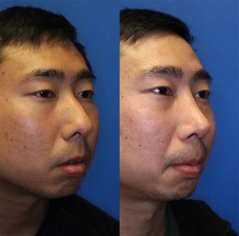 Nose Surgery Before And After Photos Patient 251 San Francisco Ca
