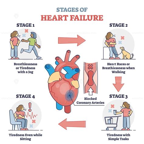 The Different Stages Of Heart Failure Kauvery Hospita Vrogue Co