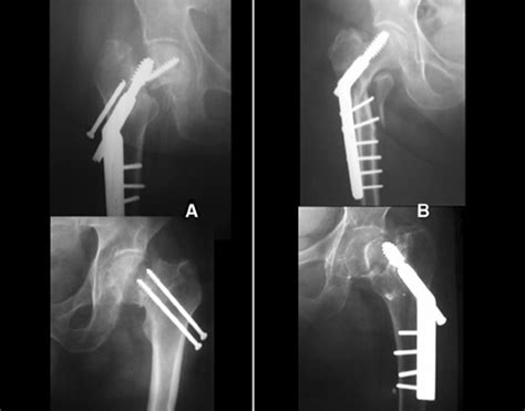 Hip Fractures Dr Girish Dewnany