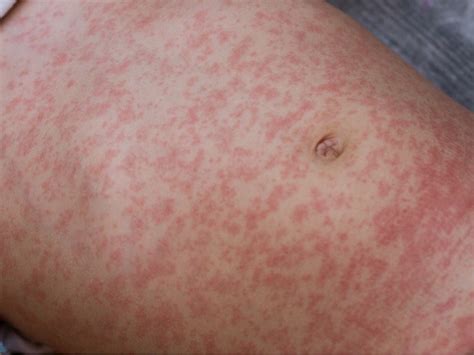 More Potential Measles Exposures Prompts Alert From Philly Officials
