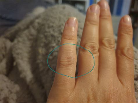 Lump On Finger Joint Rankylosingspondylitis