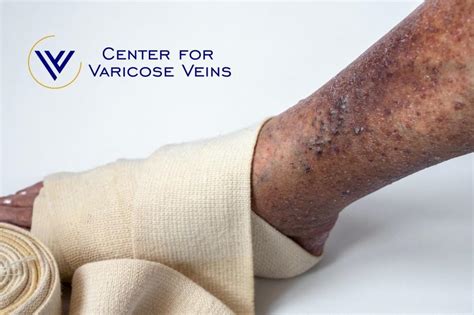 What Are The Complications Of Untreated Varicose Vein Disease Center