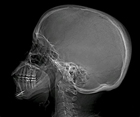 Water alone usually results in inadequate distension due to rapid reabsorption, although some authors advocate its use 9. Skull x-ray. Causes, symptoms, treatment Skull x-ray