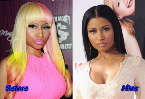 Nicki Minaj Plastic Surgery Procedures