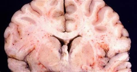 The herpes virus travels from the epidermis along the nerve paths to the trigeminal ganglion, a bundle of nerves close to the inner ear, where it lies hidden. Medical Treatment Pictures-for Better Understanding: Herpes Simplex Encephalitis