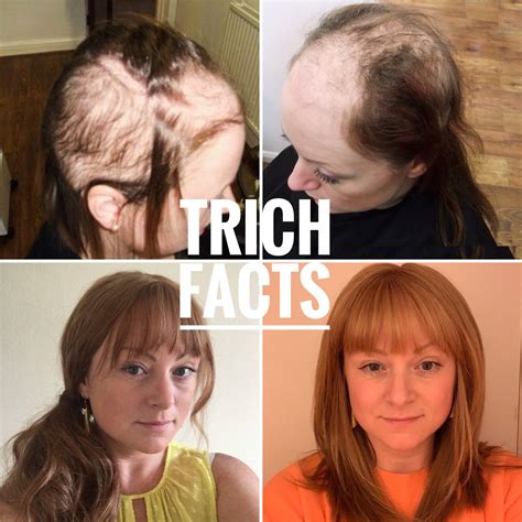 Trichotillomania Is An Impulse Control Disorder Where The Person Feels