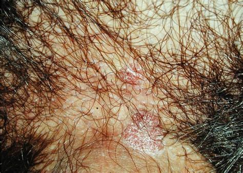 Bowenoid Papulosis Pictures Causes Symptoms And Treatment