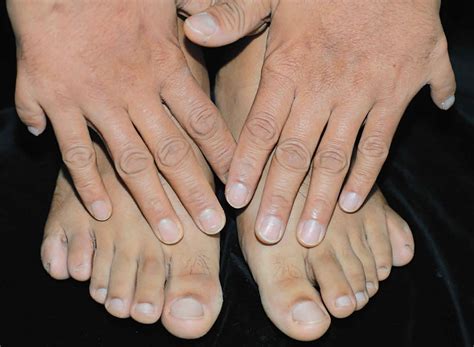 Polydactyly Causes Genetics Types And Polydactyly Treatment