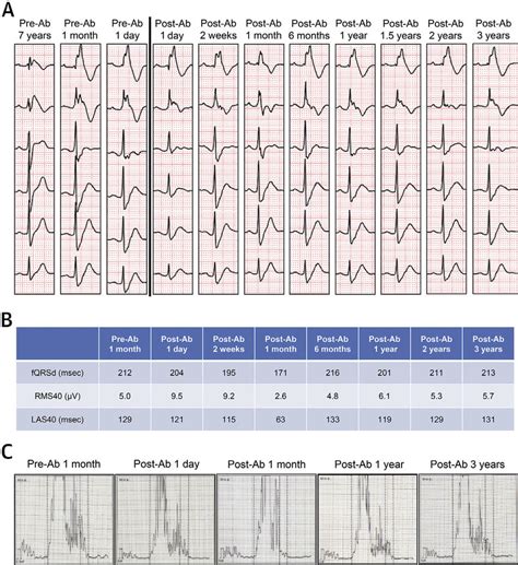 Time Course Of The Precordial Leads From The 12 Lead Ecg And